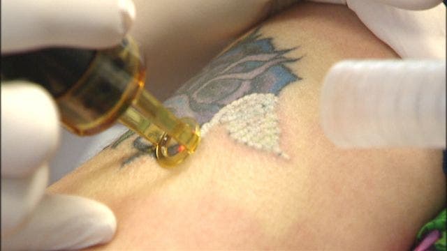 New procedure drastically cuts tattoo removal time